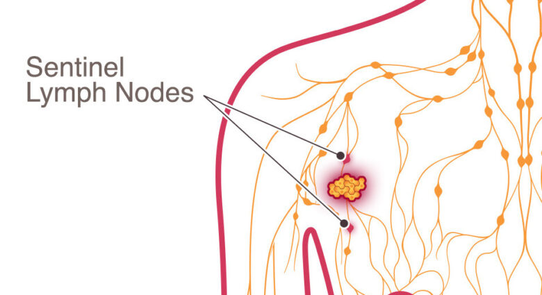 Removal of sentinel lymph nodes in Germany