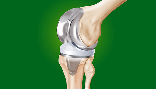 Knee replacement