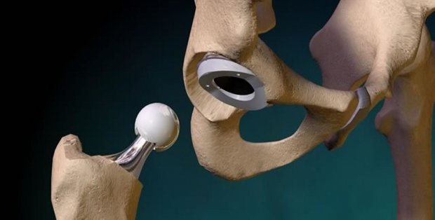 Hip replacement