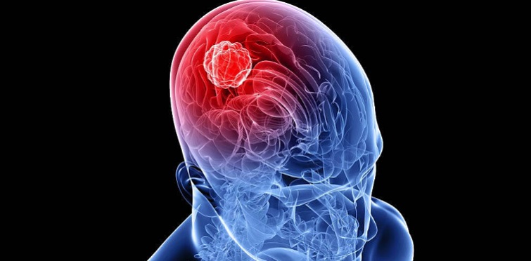 Brain cancer treatment