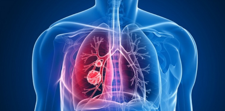 Lung cancer treatment in Germany