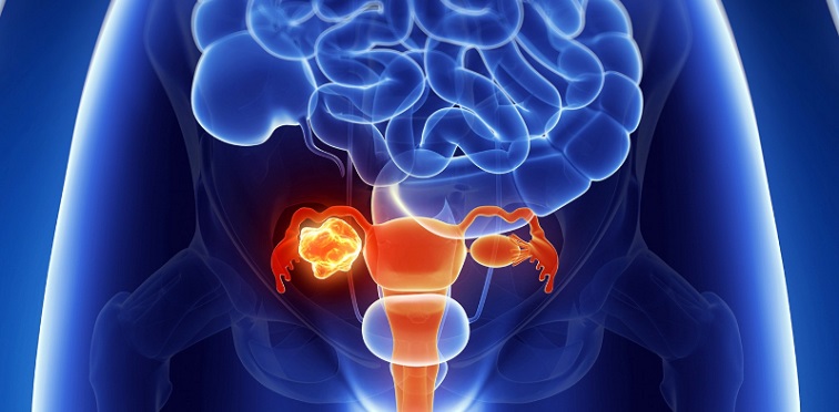 Uterine cancer treatment