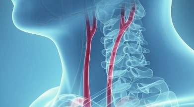 Carotid stenting