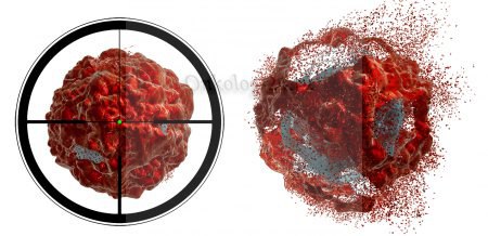 PSMA radiotherapy - treatment of prostate cancer with metastases