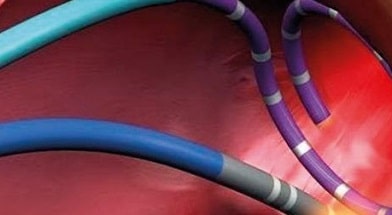 Catheter ablation and electrophysiologic study (EPI) of the heart