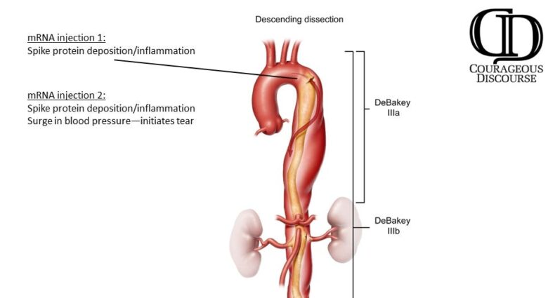 Aortic dissection