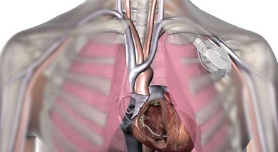 Implantable Cardioverter Defibrillator