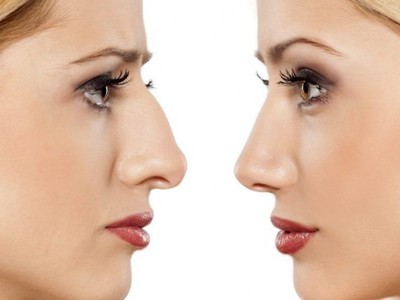 Rhinoplasty in Germany