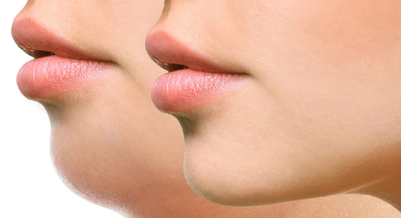 Non-surgical chin lift methods