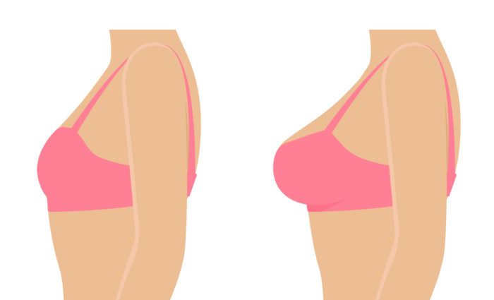 Surgical breast augmentation