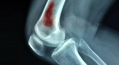 Treatment of osteomyelitis in Germany