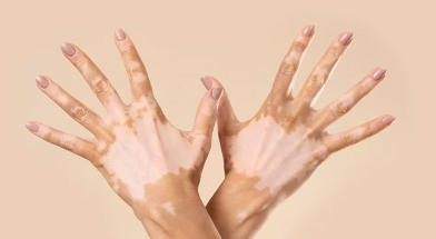 Vitiligo treatment in Germany